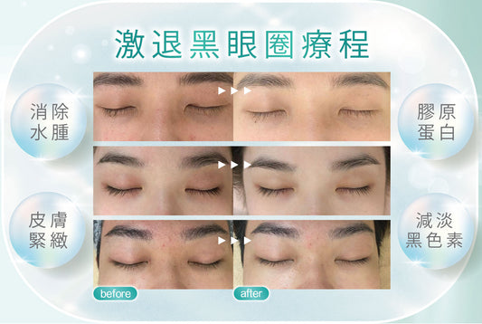 【 激退黑眼圈療程 】