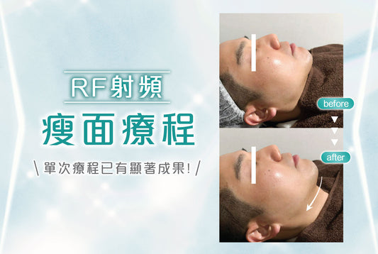 【RF 射頻瘦面療程】