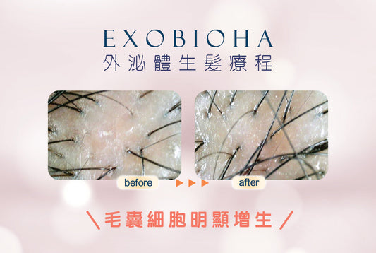 【Exobioha外泌體生髮療程💆🏻♂️💆🏻♀️💯 】