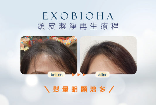 Exobioha外泌體生髮療程💆🏻♂️💆🏻♀️💯 】