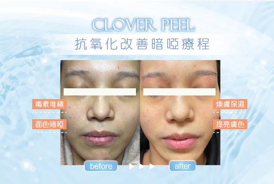Clover Peel 多重煥膚💧抗氧化改善暗啞療程